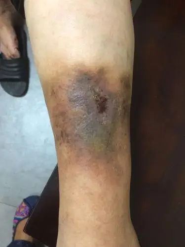 小腿慢性溃疡,静脉曲张(一例),高女士,60岁,在欧洲城卓越国际少儿英语