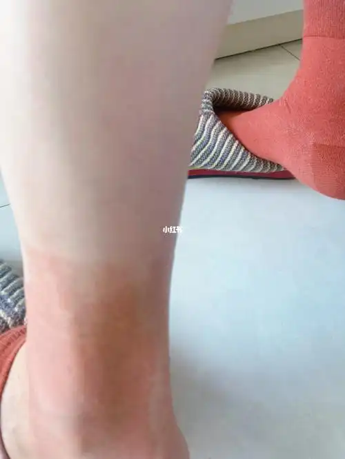 过敏红肿,尝试了很多方法,擦了碘酒,皮炎平,还有红霉素软膏以及图中的