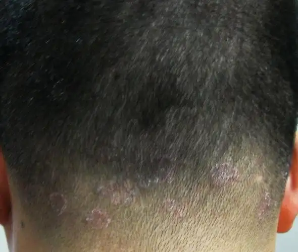 后脑勺长红点,热了就痒,请问怎么处理?