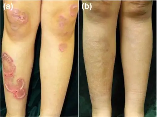 病例报告:水浴 puva 治疗皮下型环状肉芽肿