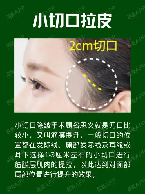 今日盘点小切口拉皮和大拉皮的区别