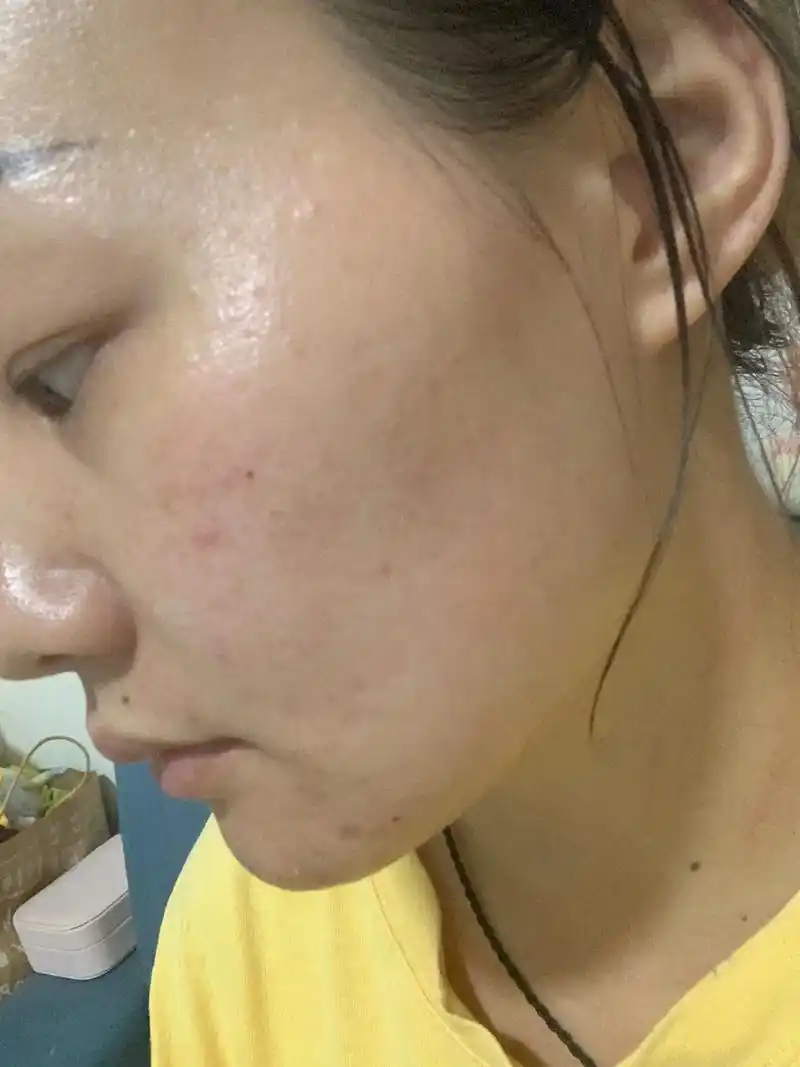 三十岁这样的皮肤状态正常吗