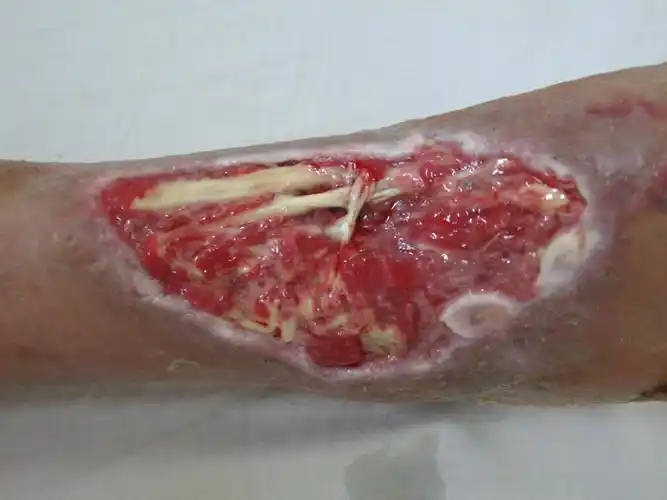 踝部绞轧伤术后一个月皮肤肌腱坏死并感染