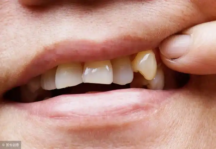 为什么有的人是28颗牙齿,有人是32颗?有人是尖牙,有人长兔牙?