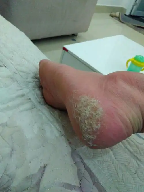 脚后跟角质层越来越厚,还有裂开的迹象,泡脚后更恐怖,手指随便一抠能
