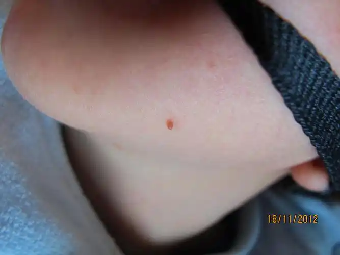 宝宝刚刚七天 脸上发现长了个这个小疙瘩 请问这是什么 会退下去吗