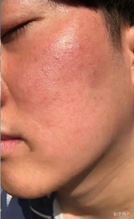 有人说皮肤屏障受损就不能修复好了角质层是不可逆的皮肤屏障受损能