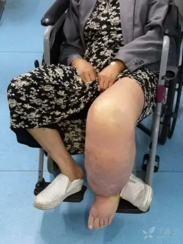 大象腿的治疗方法 - 皮肤与性传播疾病讨论版 -丁香园论坛