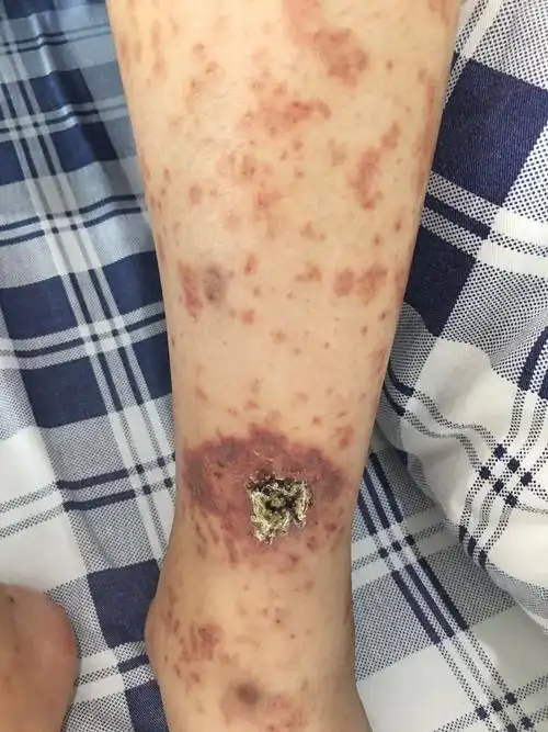 糖尿病的皮肤损害 - 好大夫在线