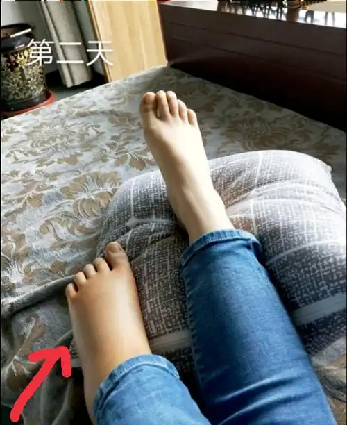 崴脚的第二天,这也肿得太可怕了吧,你们说我是不是要截肢了?