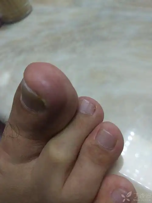 左大脚趾肿痛 [病例帖]