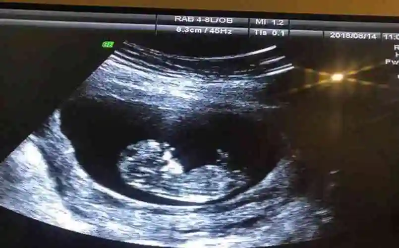 孕12周nt检查显示有三个亮点是男孩还是女孩