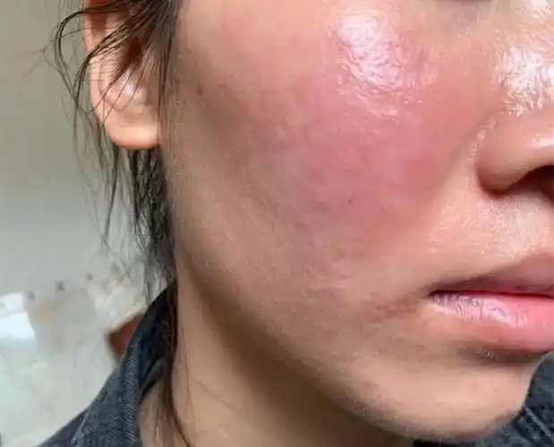 屏障受损"刚萌芽"时,皮肤隐约有4个"反常",别硬撑到"激素脸"! - 知乎