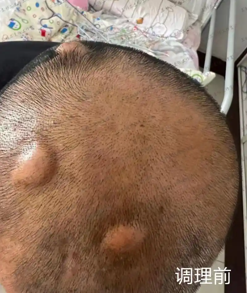 长一脑袋"鸽子蛋"大小的脓包,中医辨证,让毛囊炎无处可逃!