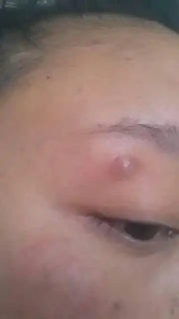 眼睛皮上长了个肉丁,曾以为是痘痘,过一段时间会消