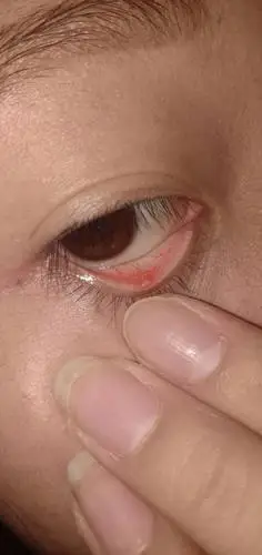 下眼皮有小泡磨眼睛怎么回事?