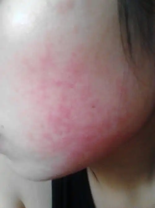 我的脸上红红的一大片,而且很痒,越抓越大,这是过敏了吗?