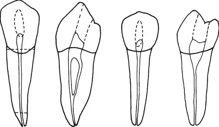下颌前磨牙髓腔略小于相对上颌牙,下颌前磨牙多为单根管牙(图7),牙冠