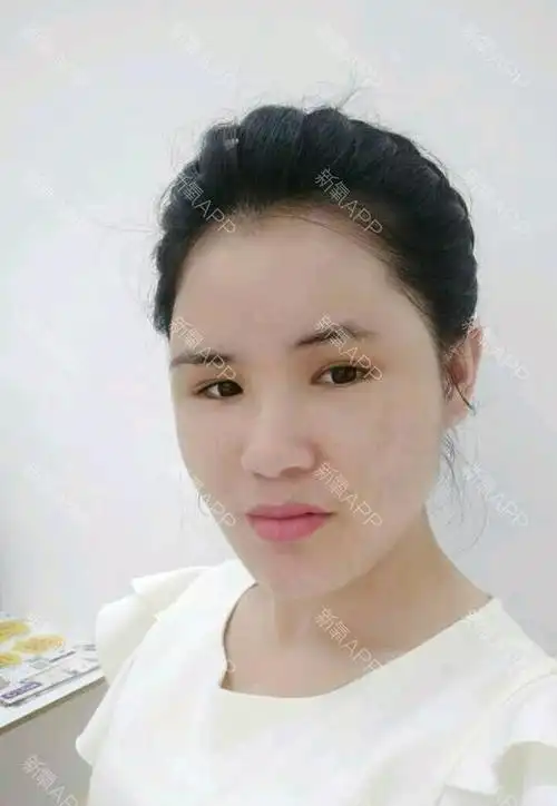 我要肉很多自体脂肪全脸填充第20天美丽日记