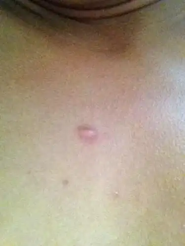 胸部上出现毛囊炎怎么办怎么使他消退