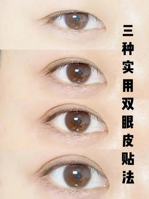 三种实用双眼皮贴法