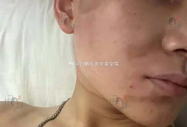 白癜风患者可以吃方便面吗?