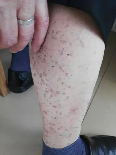 大家好,我老爸的手上和小腿上长啦好多这种斑,是什么病?