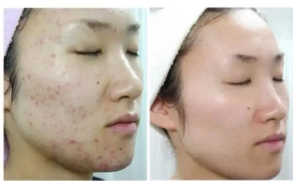 祛斑祛痘加盟资讯