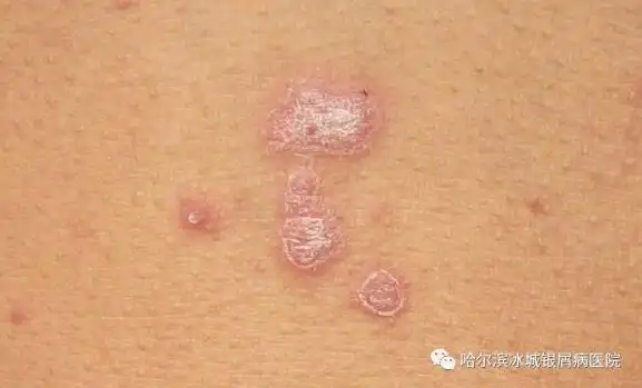 各种皮肤病对照图片100种皮肤病图片