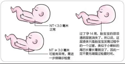 nt检查到底是什么?