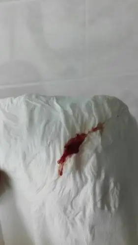 我今天白带有血,不知道什么原因只看楼主