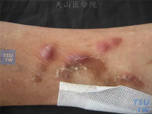 恶性肿瘤:恶性淋巴瘤及相关疾病的症状表现