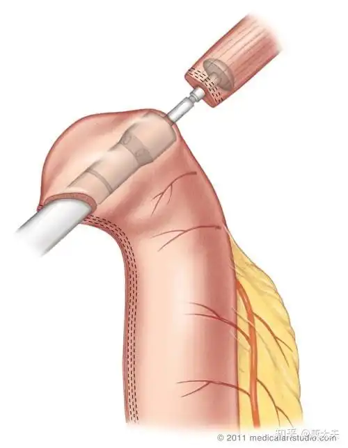 圆形吻合器辅助食管胃"端侧吻合"示意图