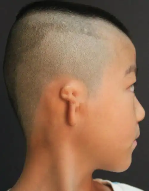 图1小耳畸形手术前图2二次法第1次手术完成后图3 第二次手术后图4 第