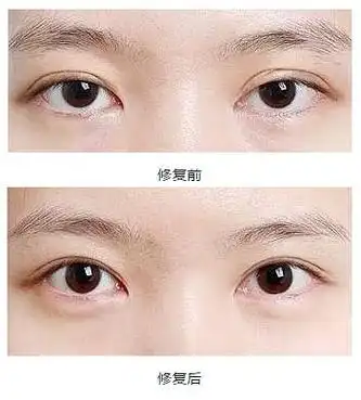 双眼皮手术修复前后对比图