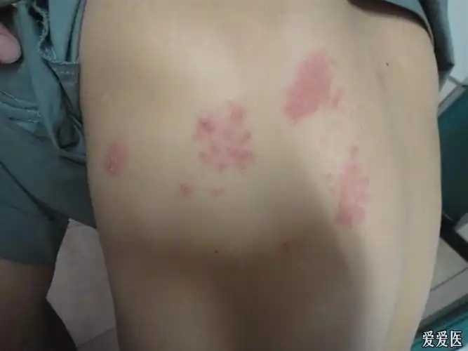 背部皮疹 - 皮肤及性传播疾病讨论版 - 爱爱医医学论坛