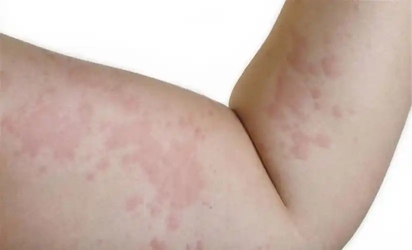 长春肤康医院浅谈:荨麻疹胸闷怎么办?