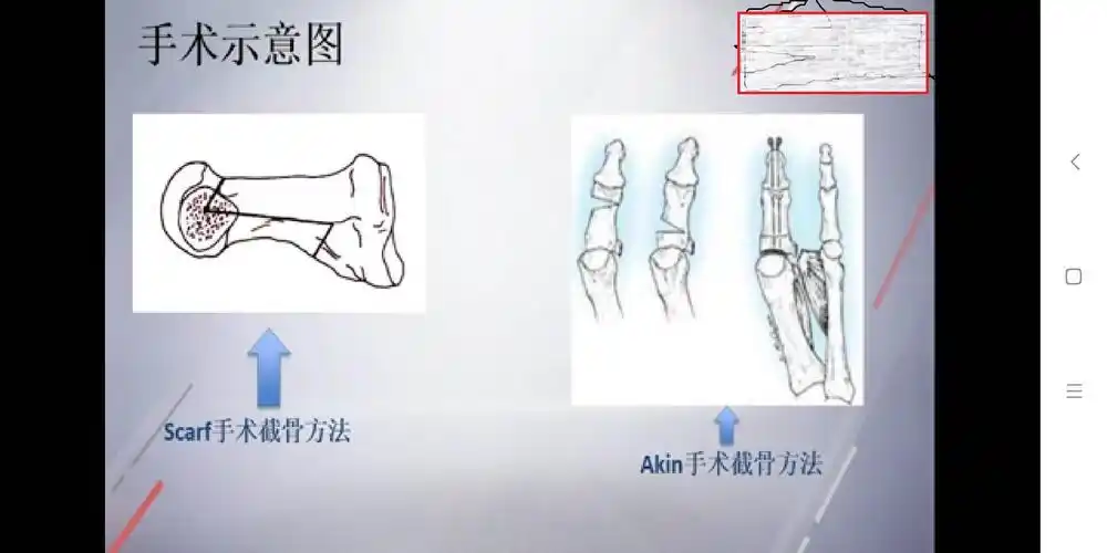 拇外翻新术式,让脚远离烦恼