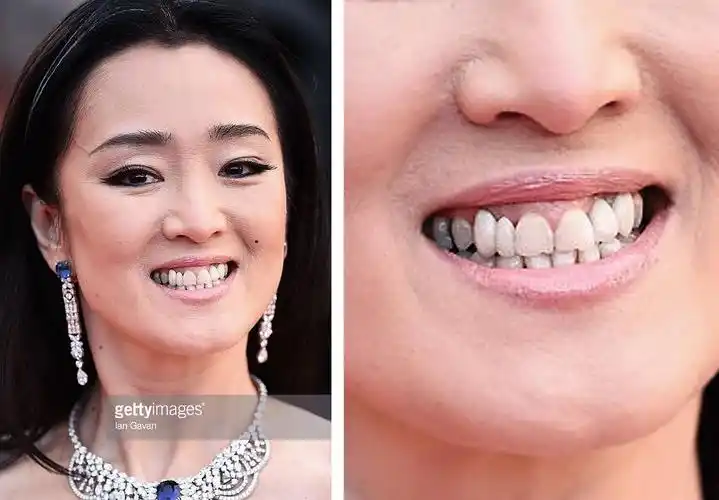 一个无聊而认真的研究:如何肉眼识别明星的假牙?