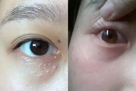 【图】脂肪粒和扁平疣的区别 相似病状需要小心对待