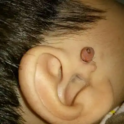 宝宝耳朵上长两个小肉丁,怎麼办