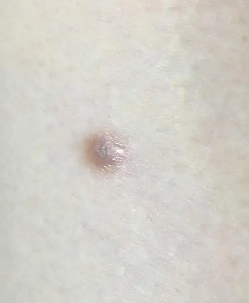 杨教授你好女32岁大腿外侧从小就有一颗高于皮肤的痘