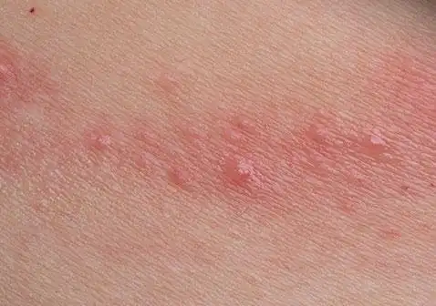 身上起红疙瘩越挠越痒接触性皮炎症状图片