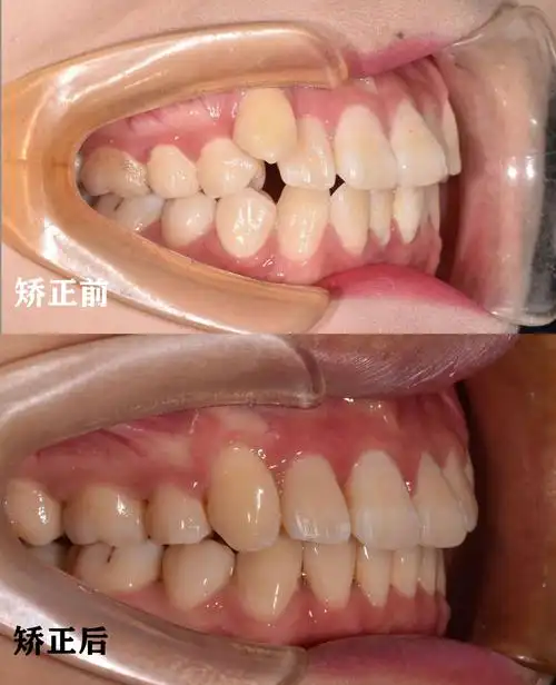 咬合良好,接下来就是好好戴保持器啦~
#虎牙突出 #虎牙矫正 #牙齿
