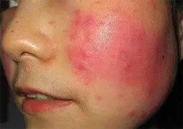 怎么修复红血丝敏感肌肤?_皮肤_屏障_丝都