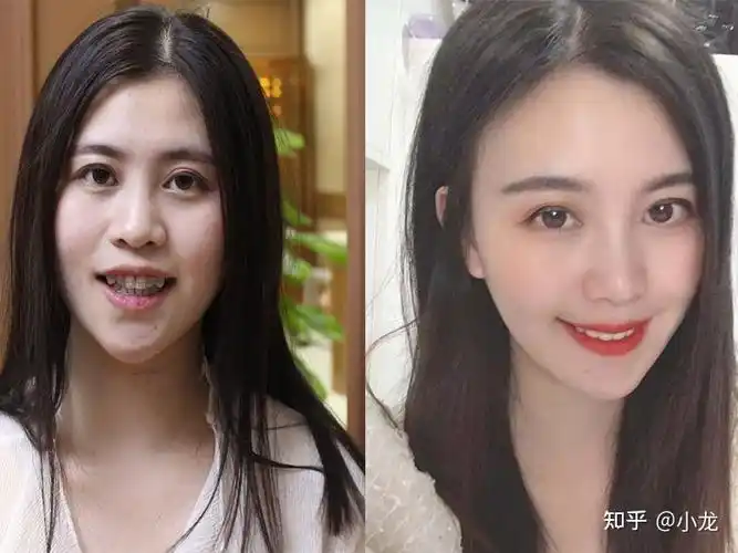 拔掉虎牙,牙齿矫正后两年的变化