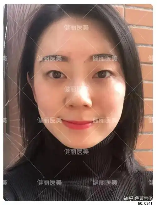 终于鼓起勇气去掉眼袋泪沟15天后效果