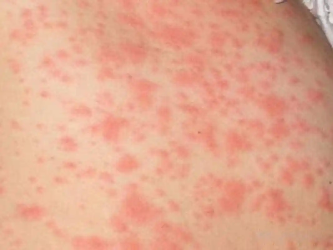 1,乳房皮肤过敏表现为皮肤发红,偶有皮疹出现,瘙痒难耐.