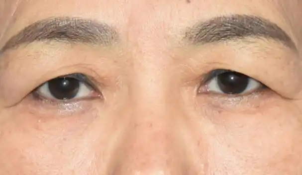 在荆州上眼皮松弛下垂该怎么办?是什么原因造成的?专家来解惑