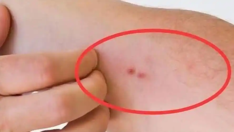 身上出现这种红点,可能是肝癌找上门,别不当回事!